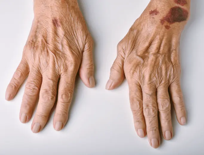 Physical abuse in Lexington, KY Nursing Home